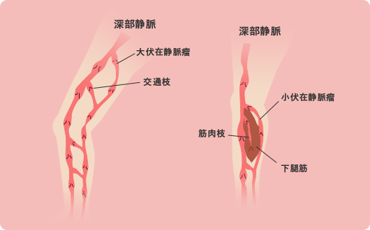 下肢静脈瘤の原因 下肢静脈瘤と診断されたら サトウ血管外科クリニック